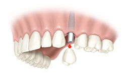Servicio implante dental